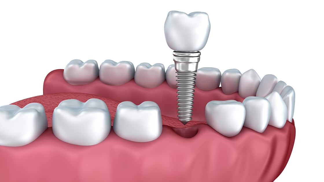 Dental Implants