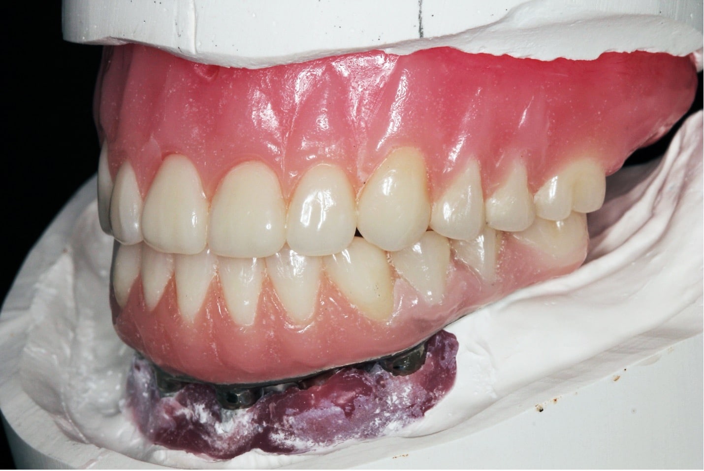 Maxillary complete mucosal borne prosthesis