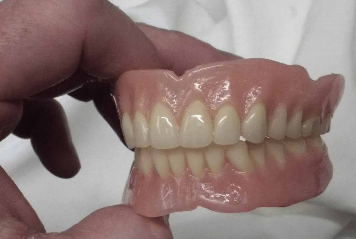 mucosal borne complete prosthetics