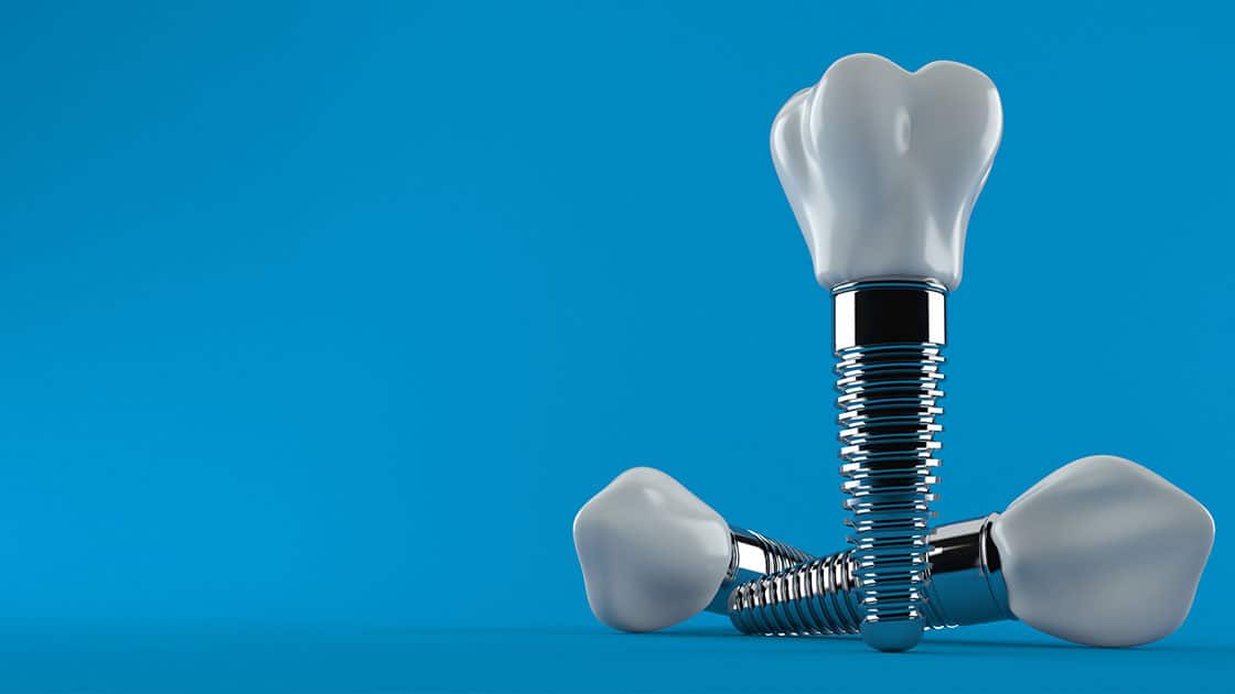 Dental Implants Image Render